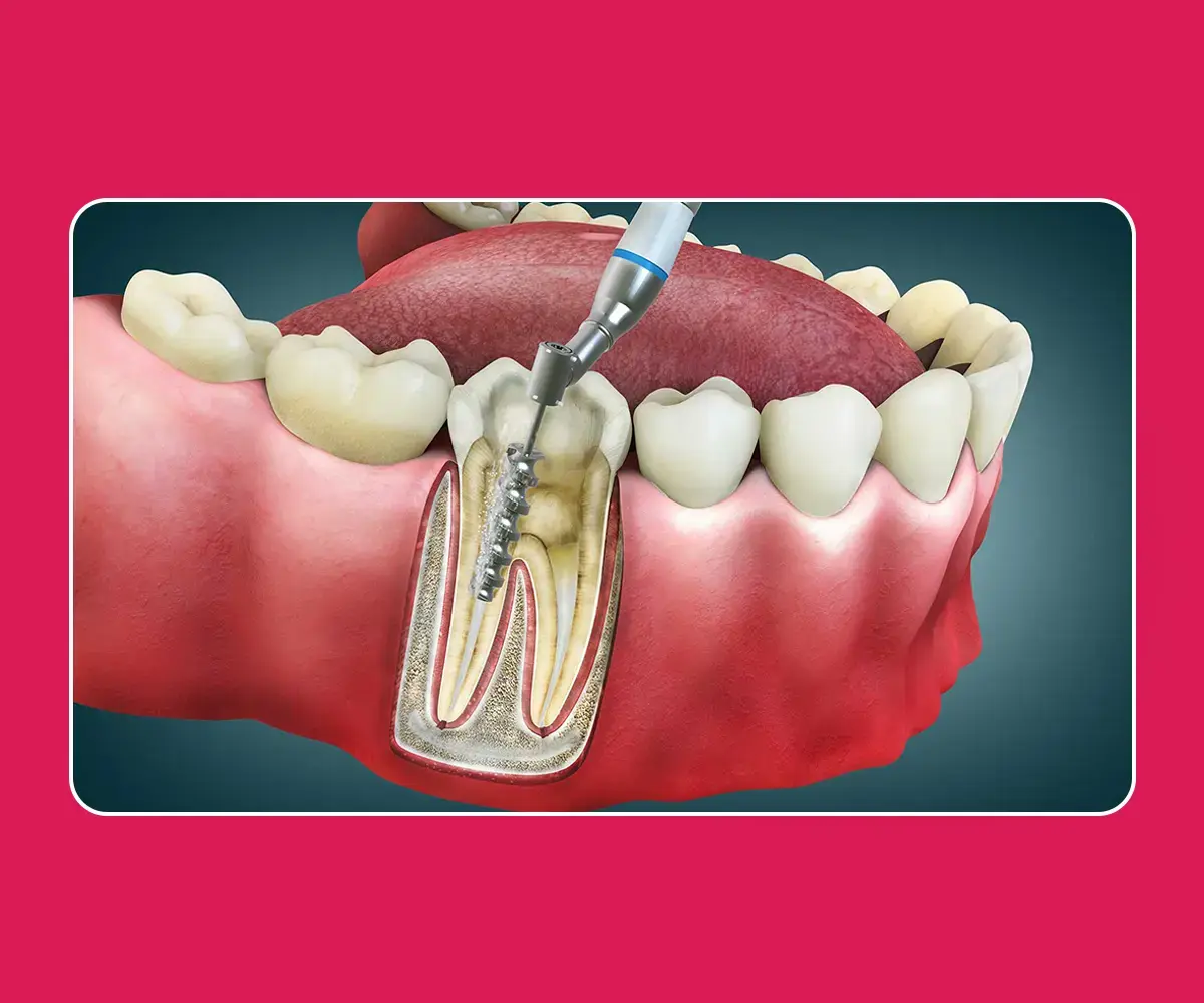 Root canal treatment at Cosmodontist Dental Clinic